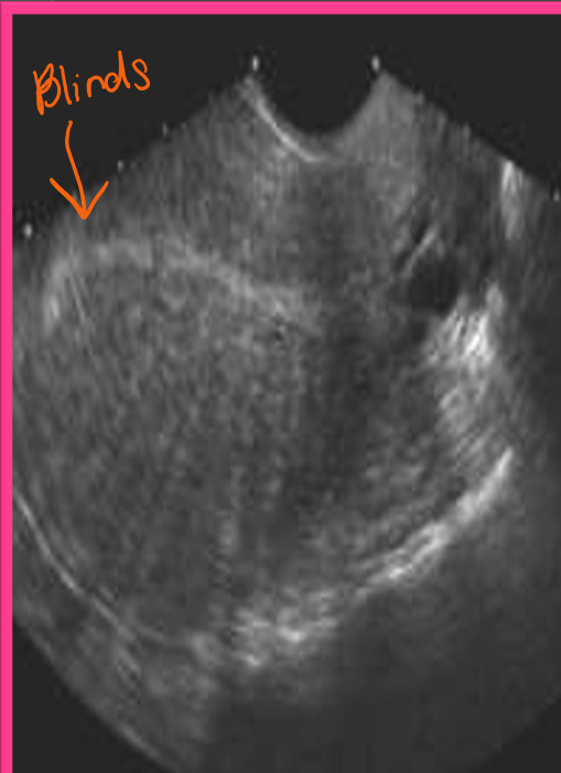 <p><span>Adenomyosis may be diffuse or focal, with ___ pattern being the most common</span></p>