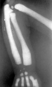 <p>Osteopetrosis</p>