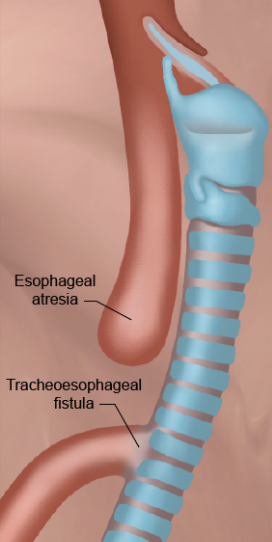 <p>a condition where the fetus’ wall between the trachea and esophagus is incorrectly developed leading to…</p><p>a) a blind pouch —> esophageal atresia </p><p><span><span>b) remain somewhat attached to the trachea forming a tracheoesophageal fistula (TEF).</span></span></p>