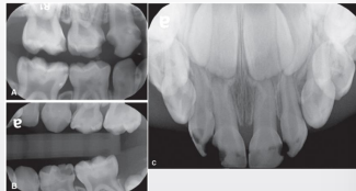 <p>rapid progression w severe widespread involvement </p>