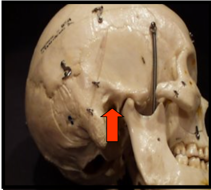 <p><span>Is a hole, or opening, in the temporal bone located superior and anterior to the mastoid process.</span></p>