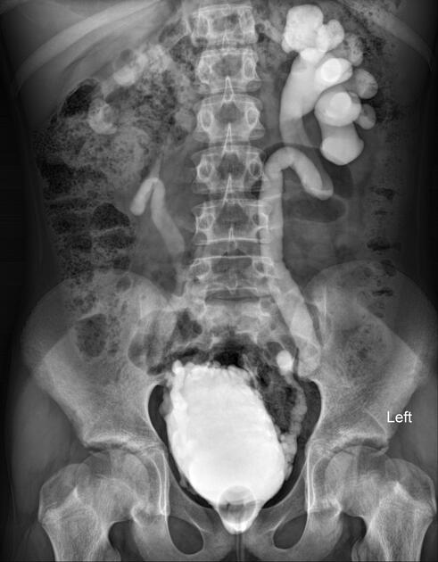 <p><span><u>Key imaging steps</u></span></p><ol type="1"><li><p><span>AP control- bladder stones, spinal anomalies</span></p></li><li><p><span>AP- filled bladder</span></p></li><li><p><span>Oblique- R and L filled bladder to see vesicoureteric junction (diverticula), grade 1 VUR</span></p></li><li><p><span>Oblique micturating- beginning, middle, end</span></p></li><li><p><span>AP film to include renal areas at the end</span></p></li></ol><p><span><em>If reflux occurs, pick up child then take a post drainage film</em></span></p><p></p>