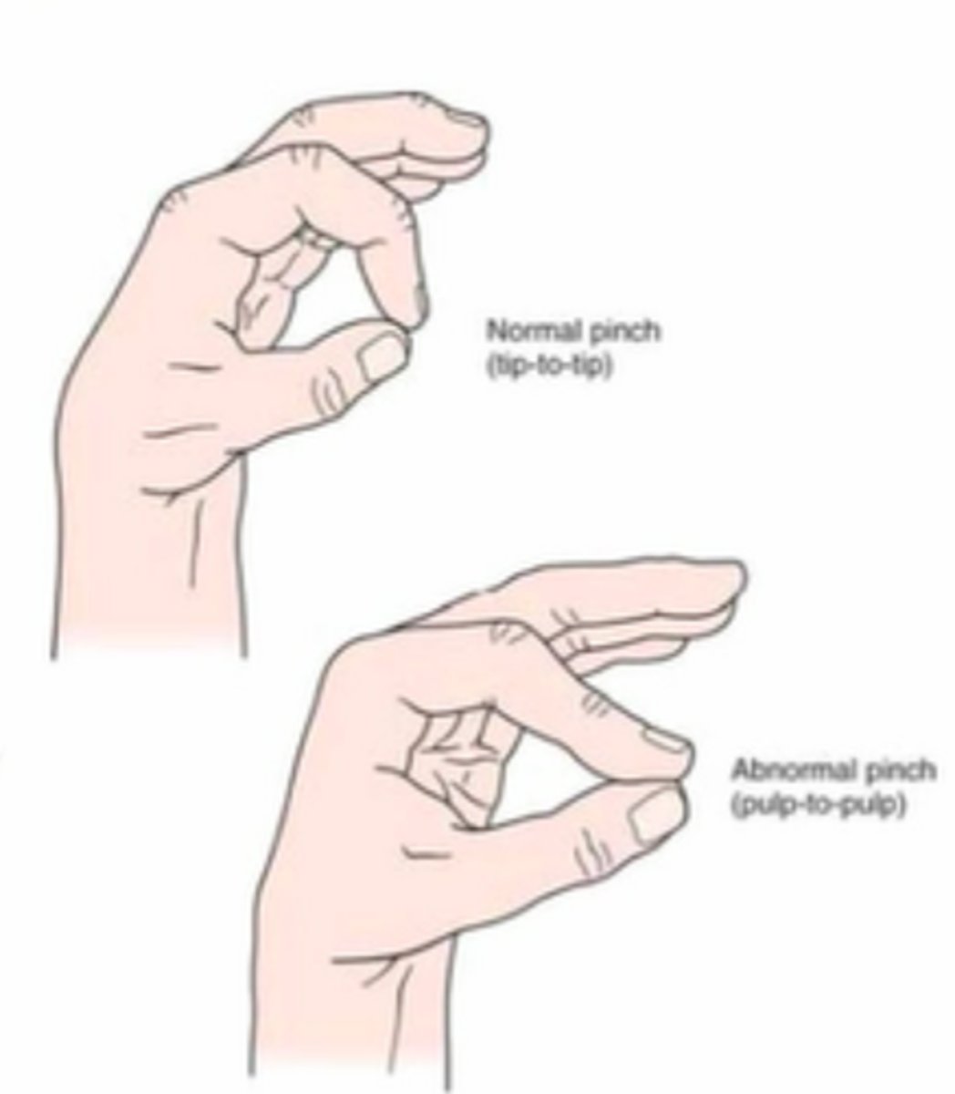 <p>pinch index to thumb (cannot pinch tip to tip--indicates entrapment of AI nerve between pronator teres)</p>