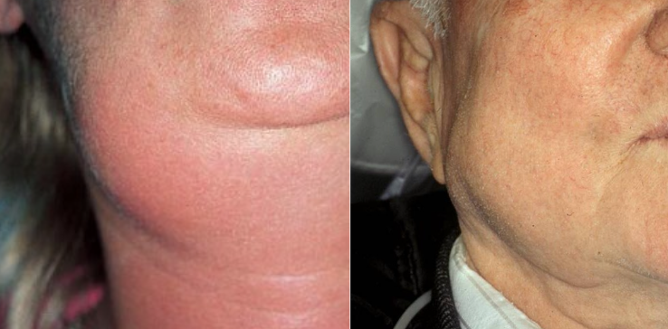 <p>What salivary gland is affected by sialadenitis?</p>