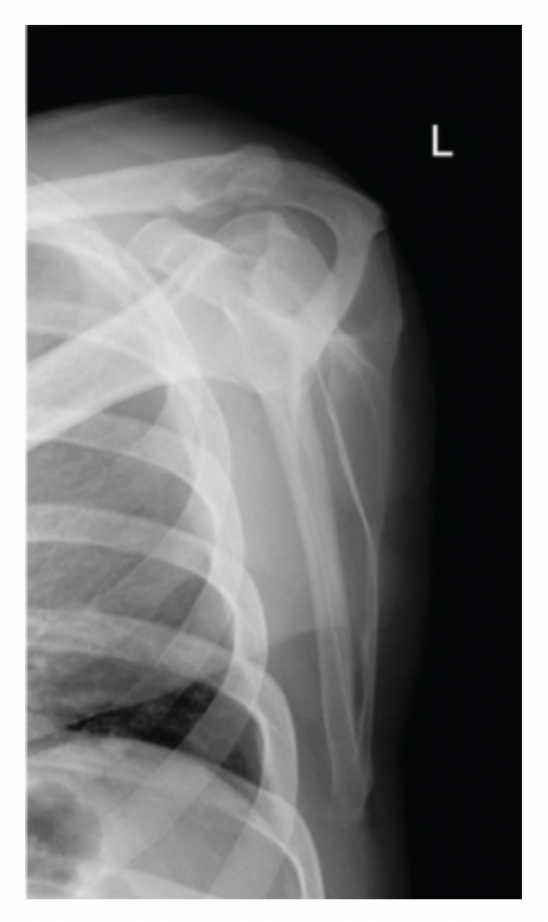 <p>A lateral scapula image demonstrates the lateral border of the scapula next to the ribs and the vertebral border of the scapula is demonstrated posterolaterally. How should the radiographer correct this image?</p><p>a. <span>Elevate arm</span></p><p>b. <span>No correction needed</span></p><p>c. <span>Increase patient obliquity</span></p><p>d. <span>Decrease patient obliquity</span></p>