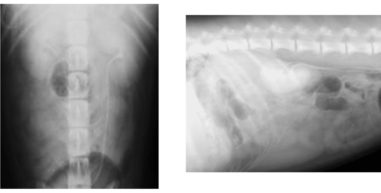 <p>This patient has been admitted for EU/IVP study.&nbsp;These VD + lateral views were taken after 20 minutes from IV administration of the contrast media. What do they indicate?</p>