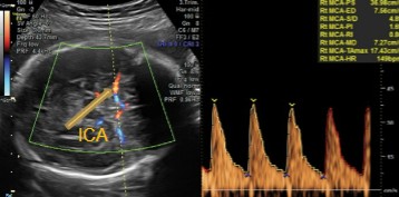 <ol><li><p>What is being dopplered here?</p></li><li><p>Is the waveform considered normal or abnormal for this vessel?</p></li></ol><p></p>