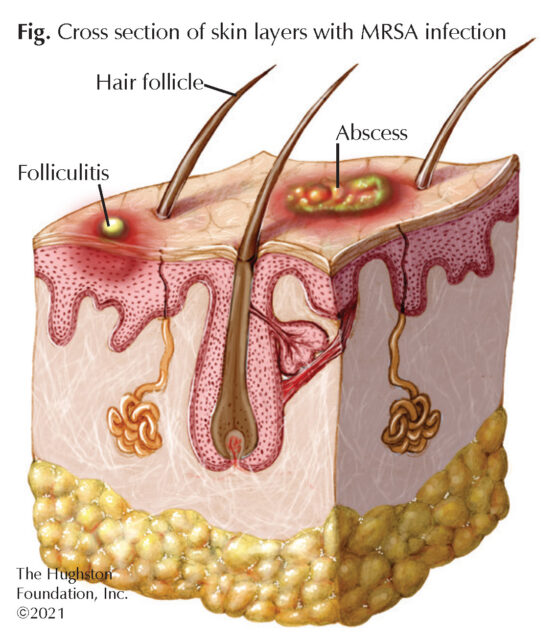 <p>What does MRSA stand for?</p>