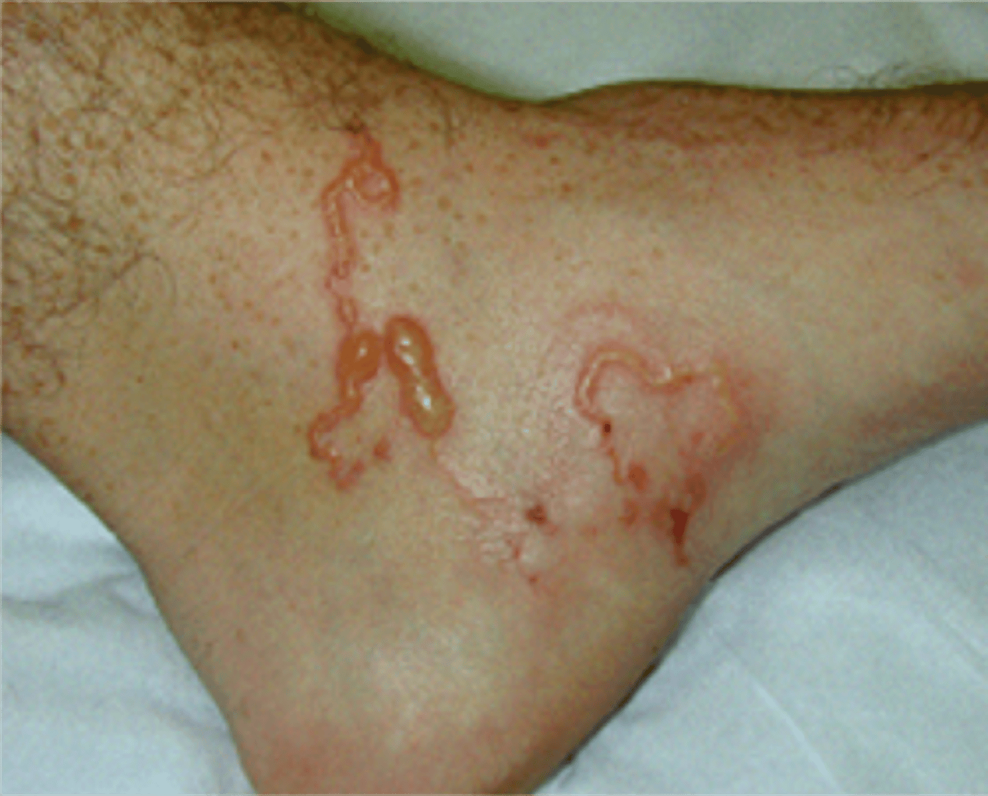 <p>anticoagulants (leading to anemia); wear shoes in endemic areas, prevent human feces from contaminating soil</p>