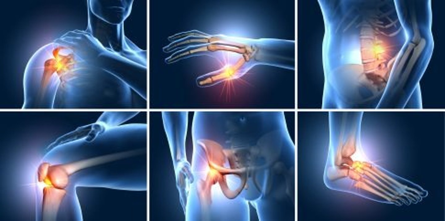 <p>typically a flare up</p><p>▪Pain</p><p>▪Inflammation</p><p>▪Hot, red joints</p><p>▪Tenderness</p><p>▪Overall stiffness</p><p>▪Limited motion</p>