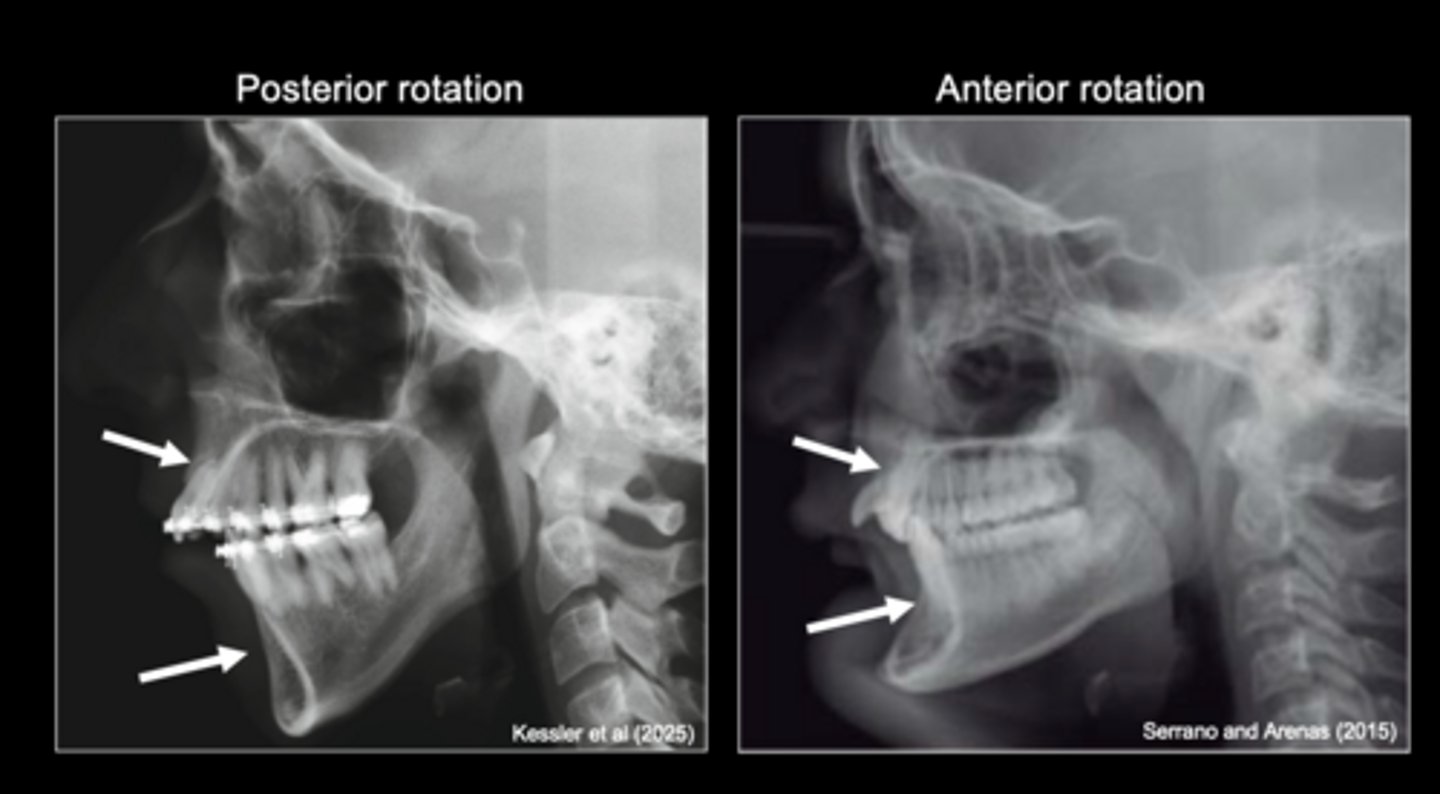<p>Mandibular rotation produces compensatory changes in</p>