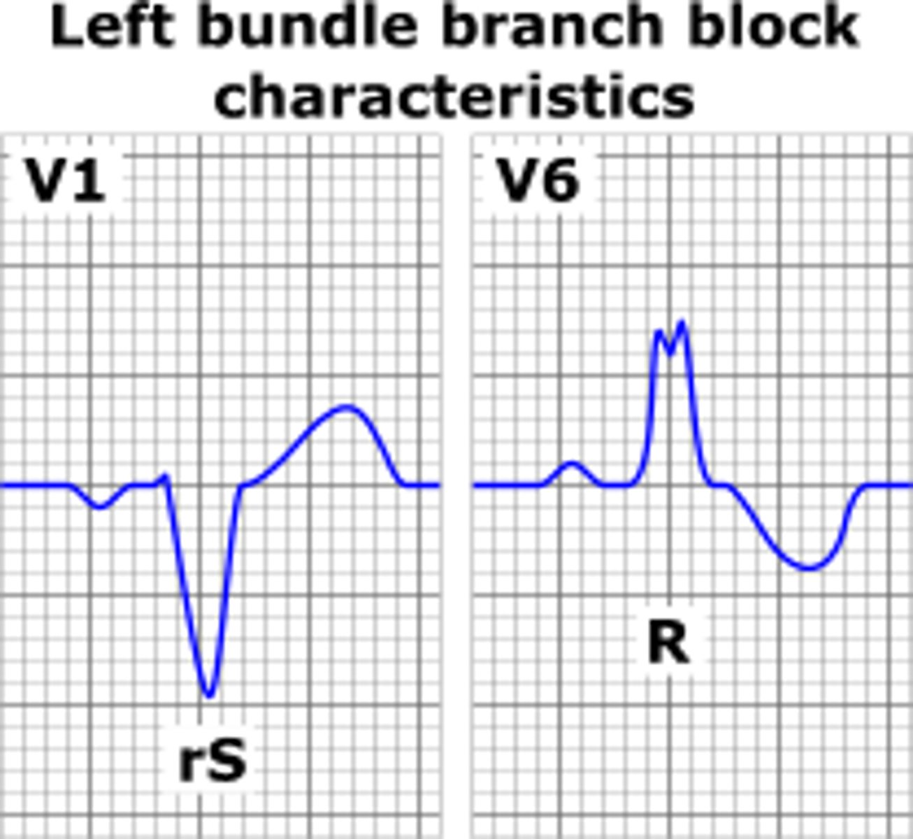 <p>V1 and V2 have neg deflection with wide QRS</p><p>widened QRS</p>