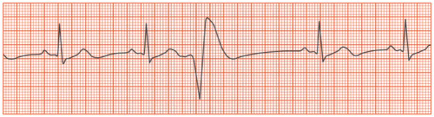 <p>B. Premature ventricular contraction</p>