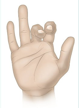 <p>Median claw when the patient tries to extend fingers </p>