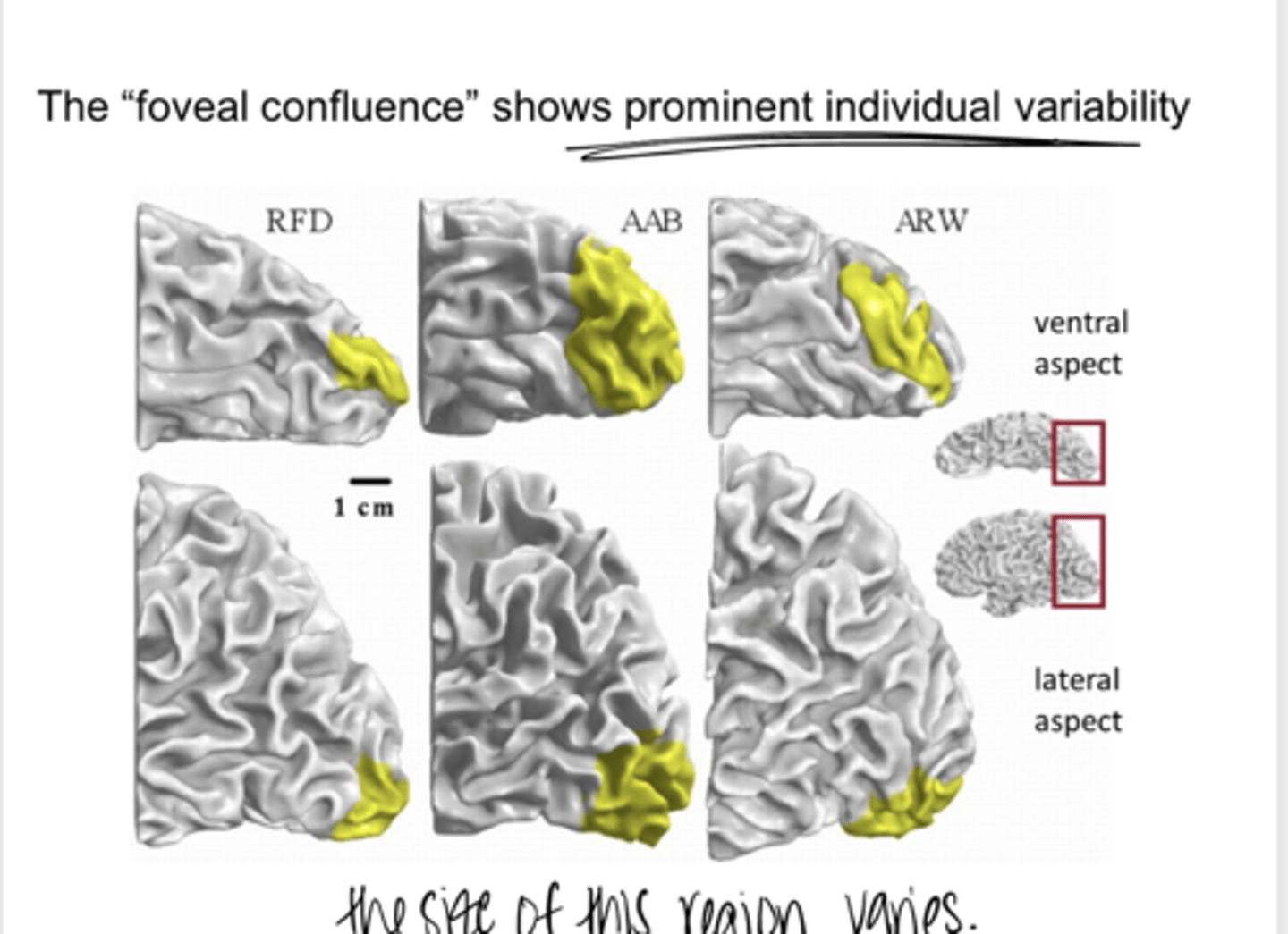 <p>The foveal confluence shows prominent individual _____</p>