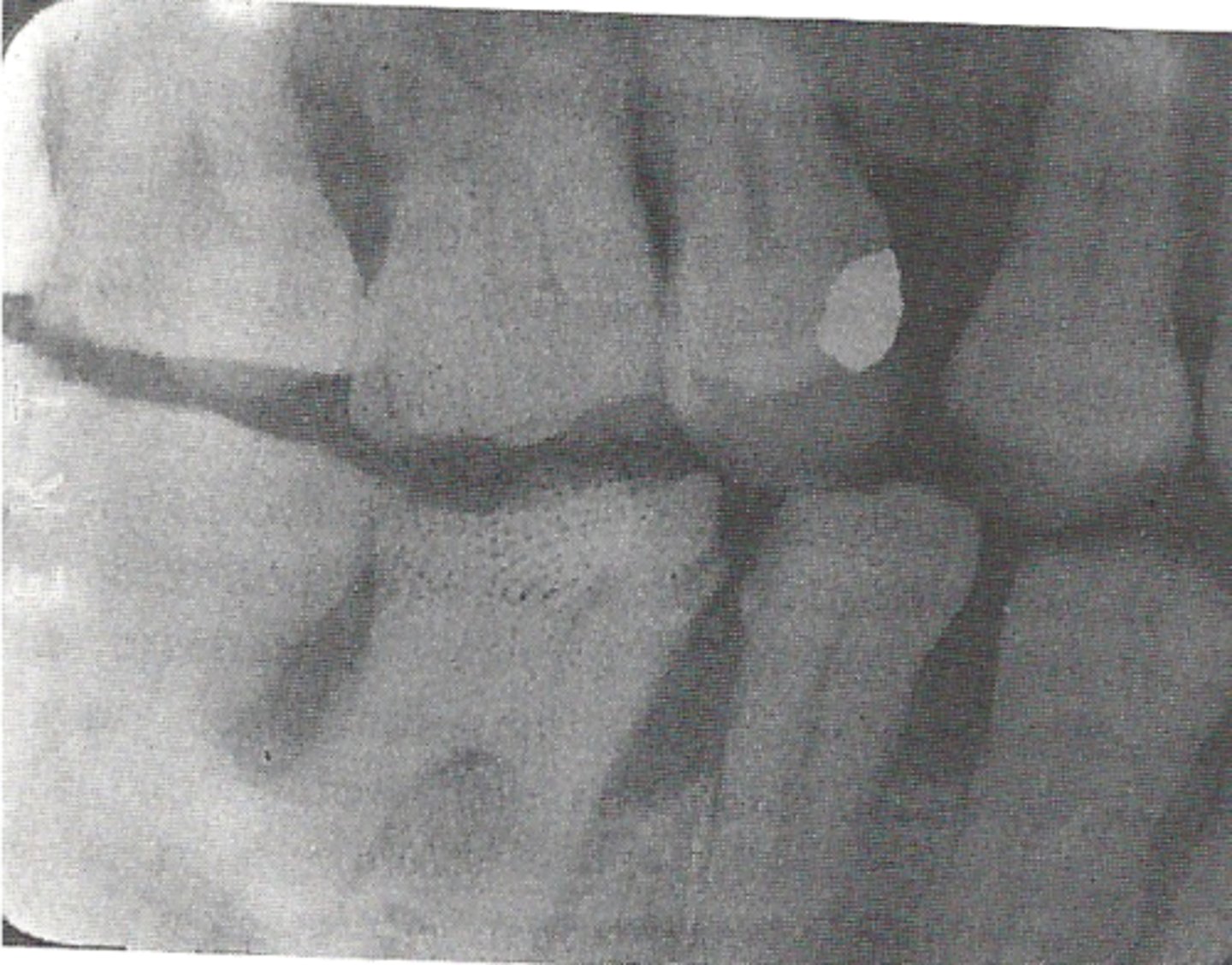 <p>hazy appearance on film</p><p>many causes</p>