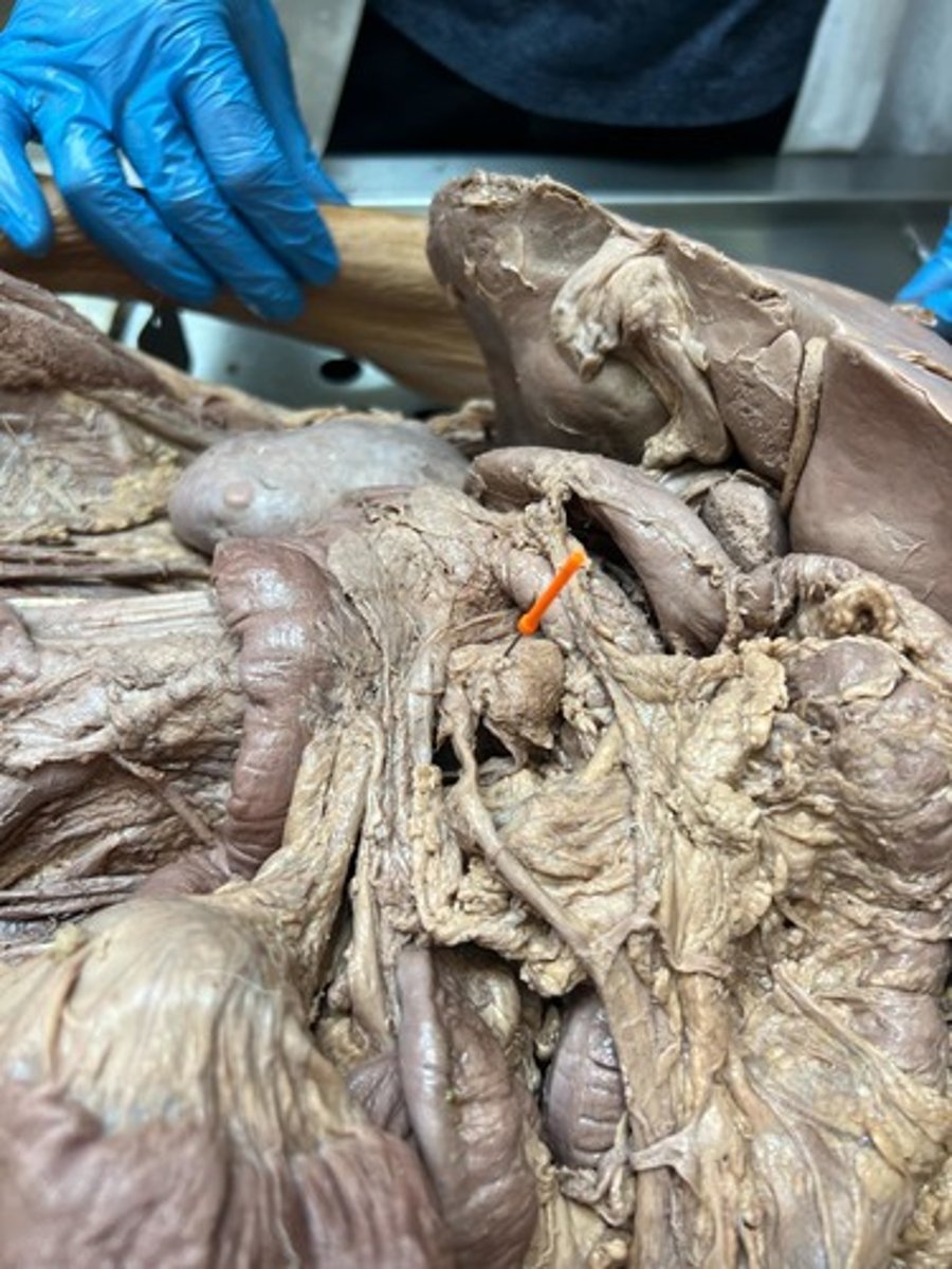 <p>ileocolic artery</p>