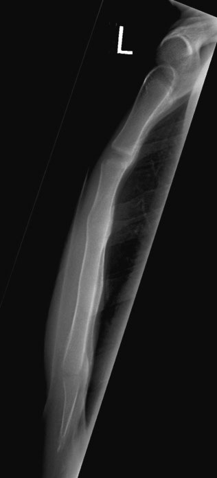<p>Is there any tilt in this LAT sternum?</p>