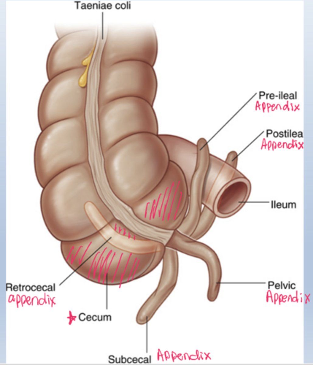 <p>The appendix can occupy several positions, altering pain location and exam findings in appendicitis.</p>