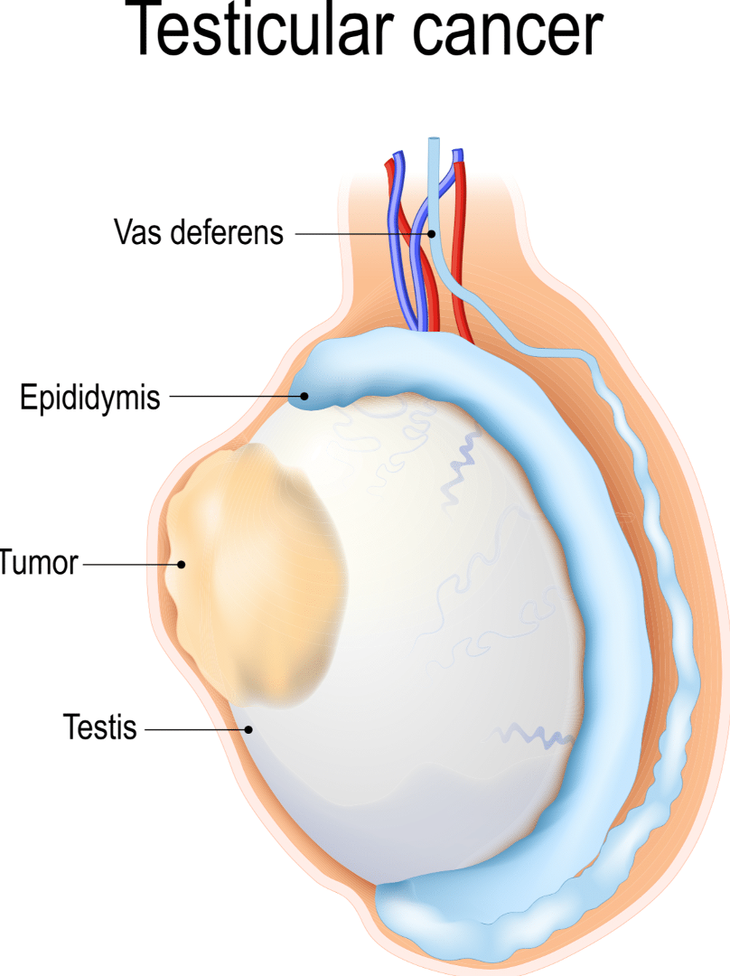 <p>Cancer of the testis</p>