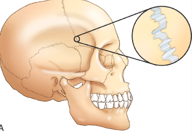<p>bones connected by fibrous tissues</p><p>allow NO MOVEMENT</p><p>ex. sutures between the bones of the skull</p>