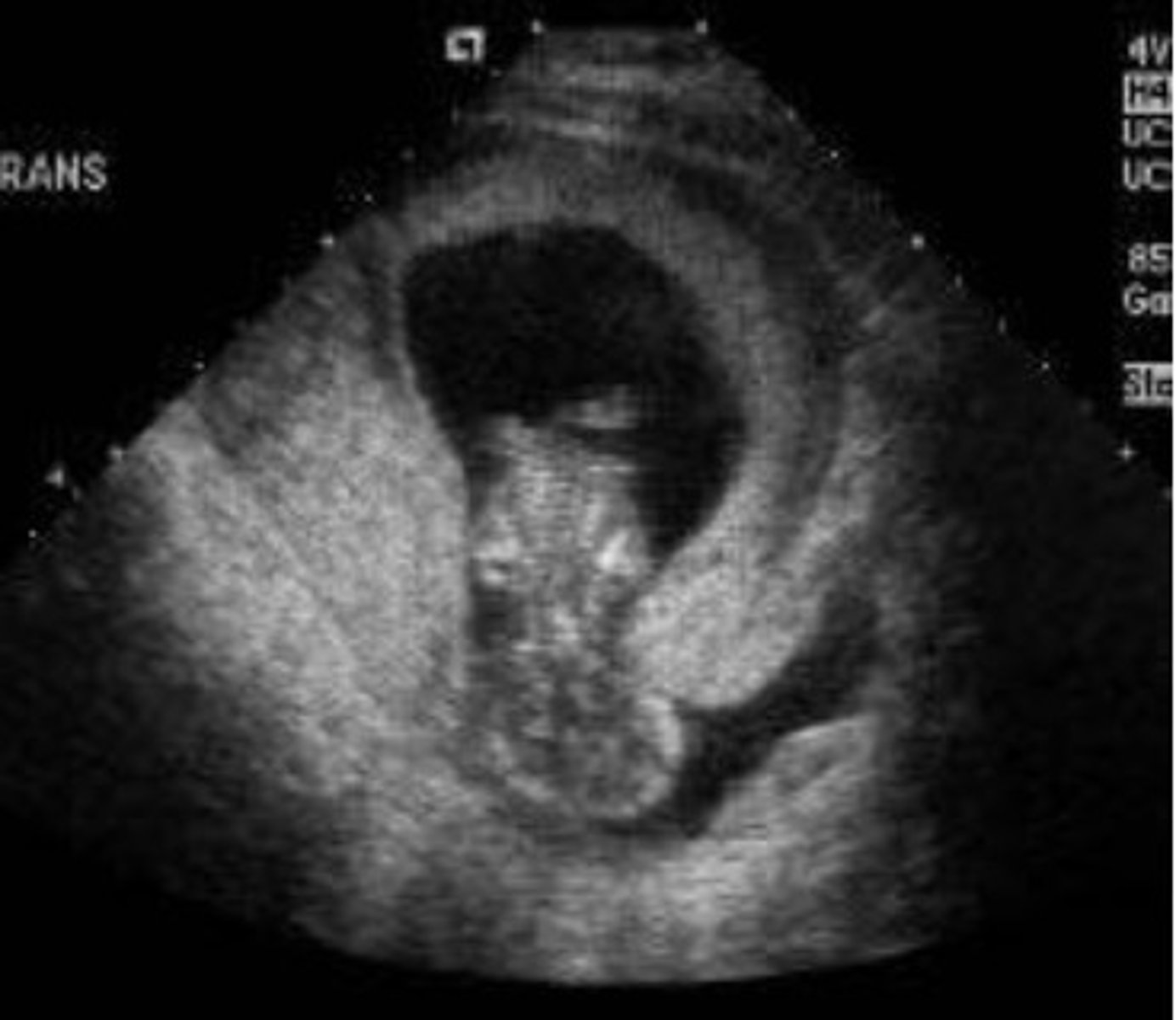 <p>the intentional ending of a pregnancy: "Abortion is illegal in some countries."</p>