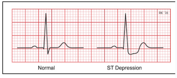 <ul><li><p><span style="background-color: transparent;"><span>Angina occurs when ischemia (decreased oxygen) in the heart activates afferent pain pathways, sending signals to the brain that are perceived as chest pain. If blood flow is not restored, this can progress to a heart attack (myocardial infarction).</span></span></p></li><li><p><span style="background-color: transparent;"><span>ECG will show ST depression</span></span></p></li></ul><p></p>
