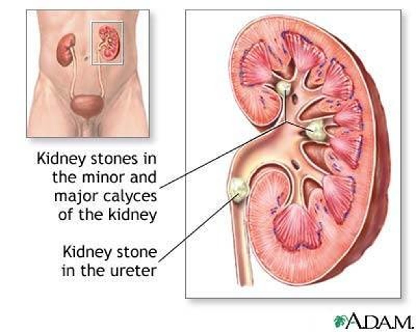 <p>Solid masses made up of tiny crystals, also known as kidney stones.</p>