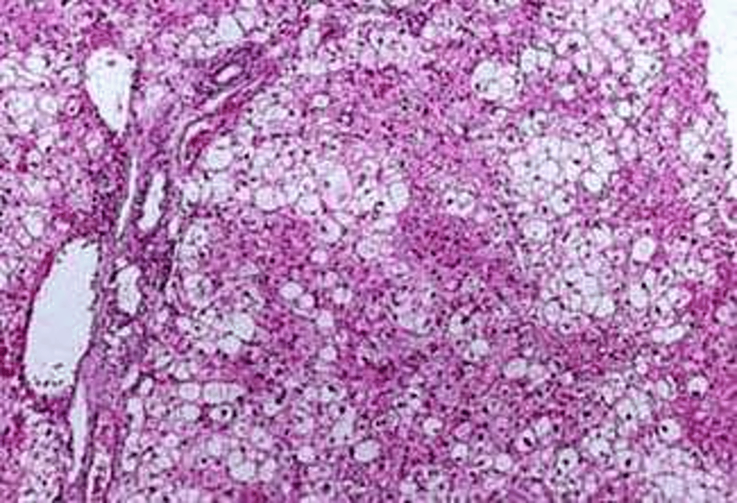 <p>Glycogen deposition and hydropic change.</p>
