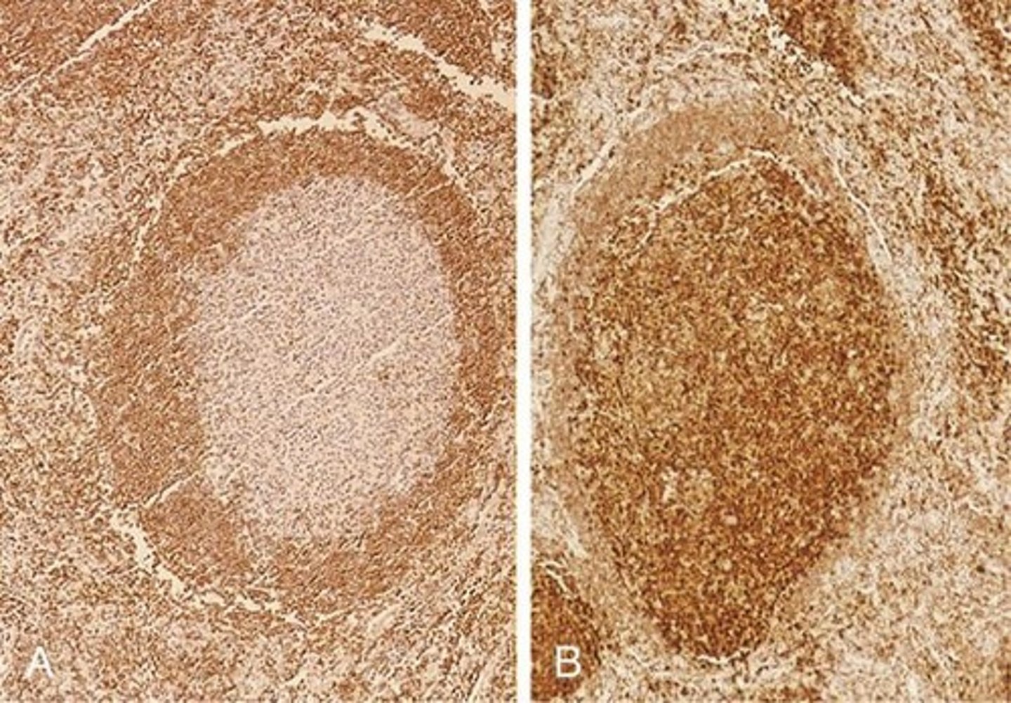 <p>The two regions are the dark zone, containing proliferating blast-like B cells (centroblasts), and the light zone, composed of B cells with irregular or cleaved nuclear contours (centrocytes).</p>