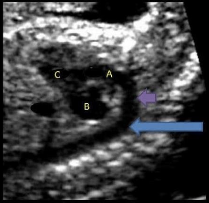 <p>what is letter B</p><p>a) left atrium</p><p>b) left ventricle</p><p>c) right atrium</p><p>d) right ventricle</p>