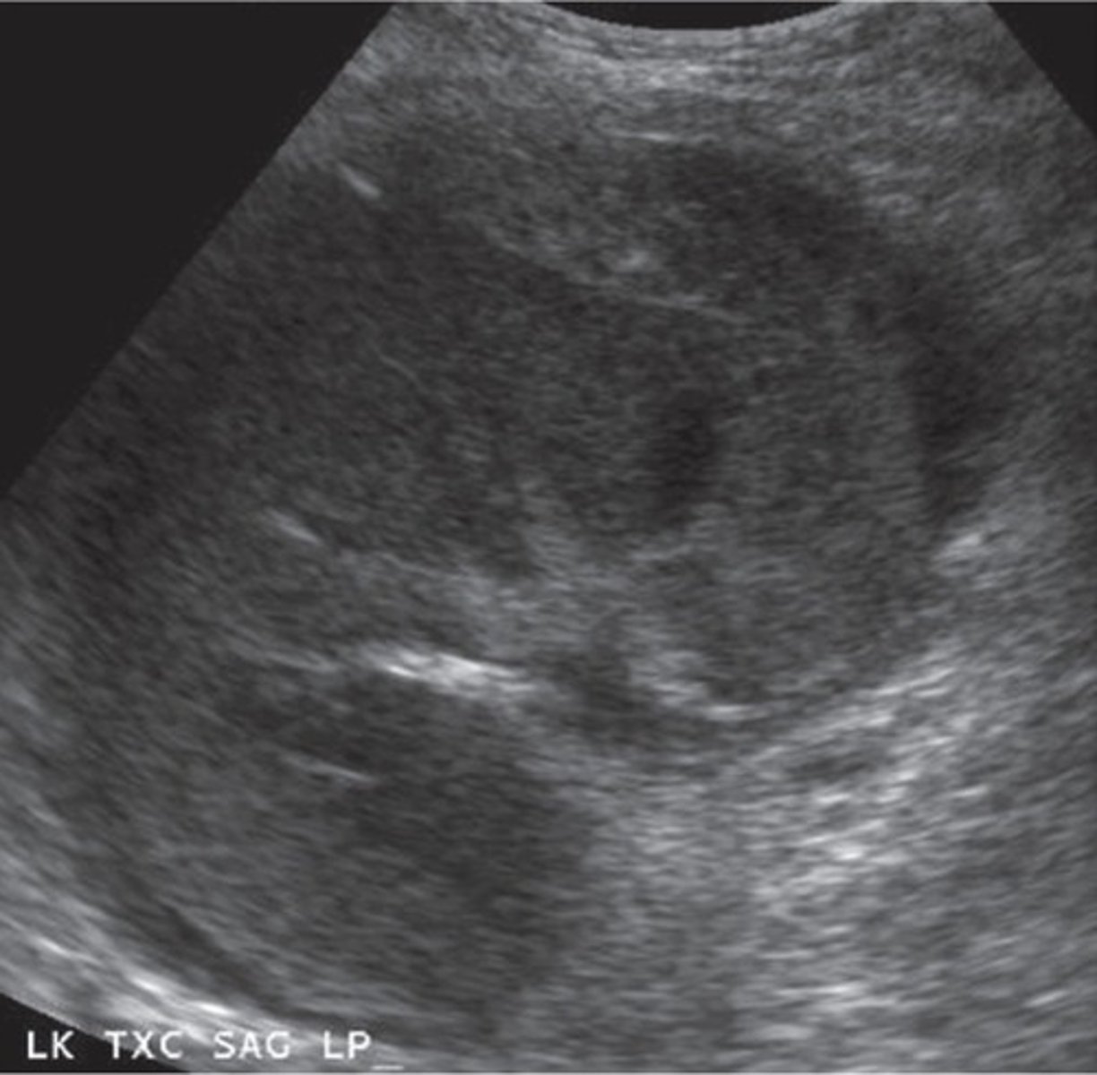 <p>Variable echogenicity - depends on time since hemorrhage occurred</p>