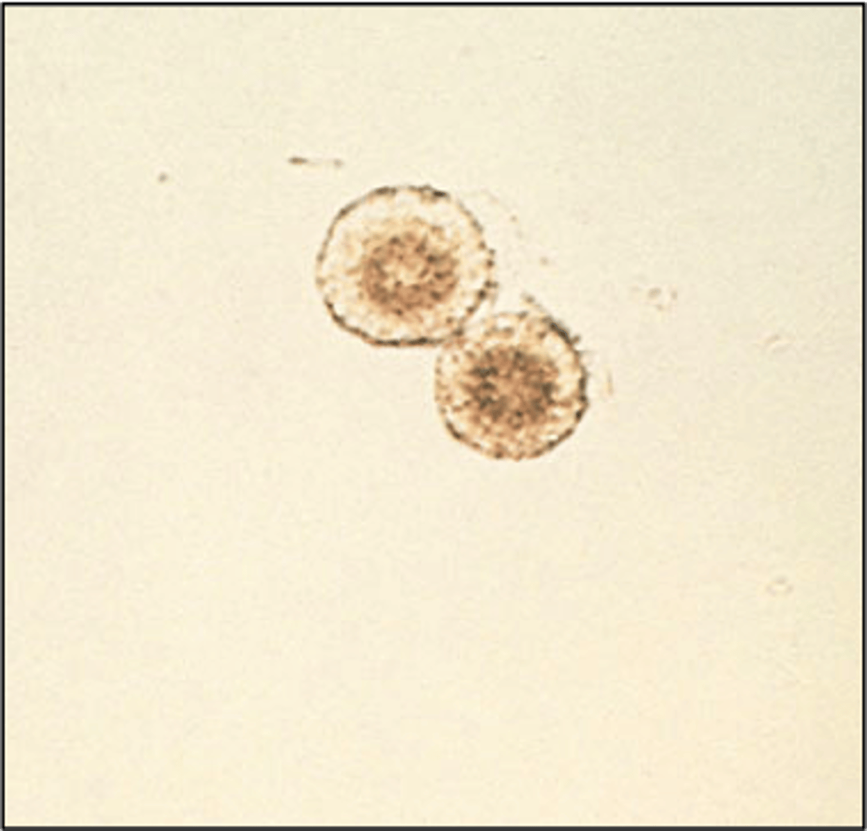 <p>abnormal, yellow-brown spheres with concentric circles and radial striations, sen with tyrosine crystals, liver disease</p>