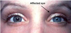<p><u>Sympathetic defect</u></p><p>Ptosis (Eyelid closure)</p><p>Miosis (Pupil constricted)</p><p>Anhidrosis (Lack of sweating on that side of face)</p><p><em>New DX is neurological emergency</em></p>