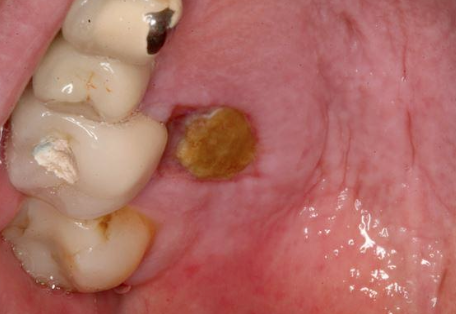 <p>WHere would you find anesthetic necrosis?</p>