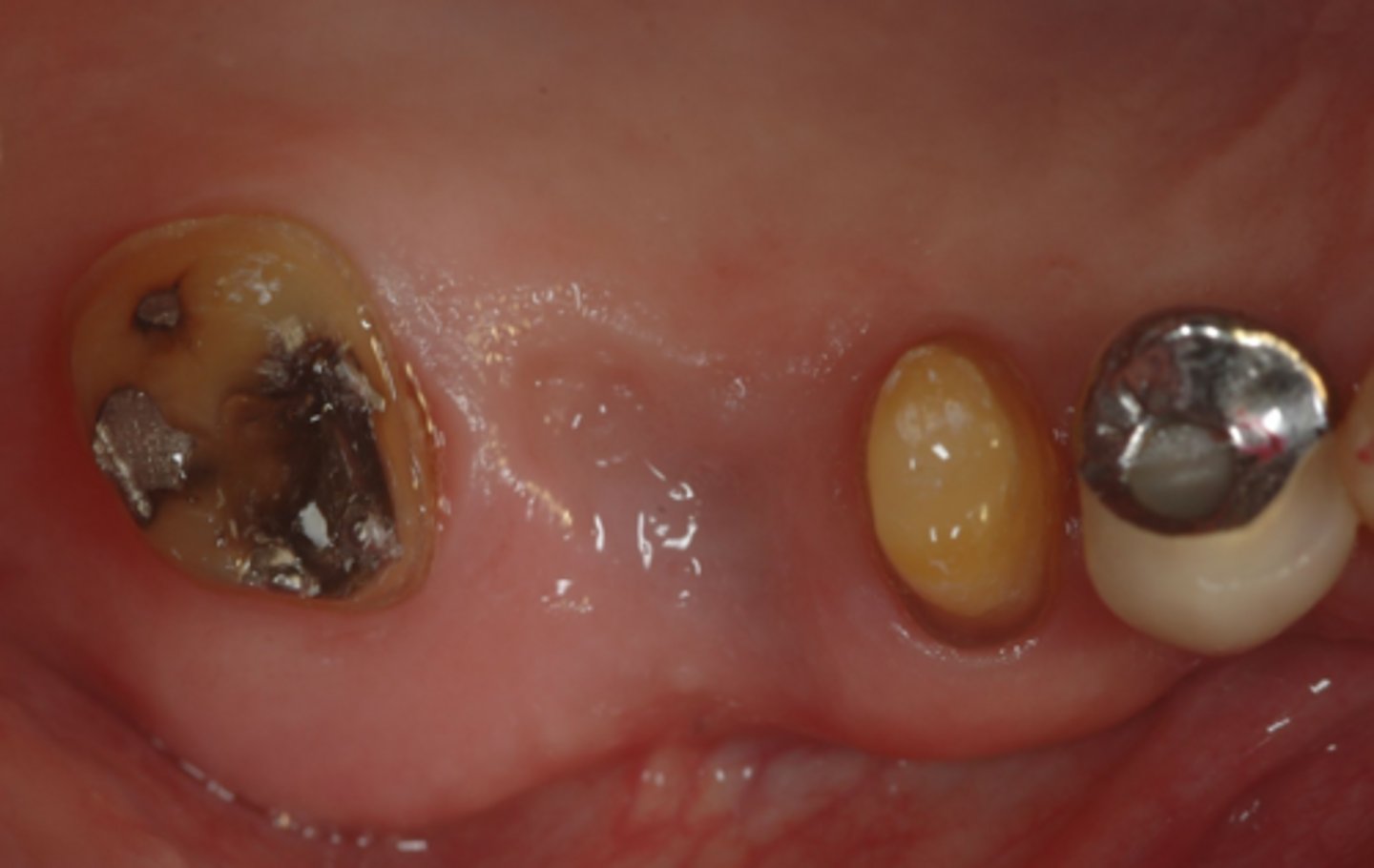 <p>Which of the four factors determining criteria for success of a provisional bridge are you most concerned for here?</p>