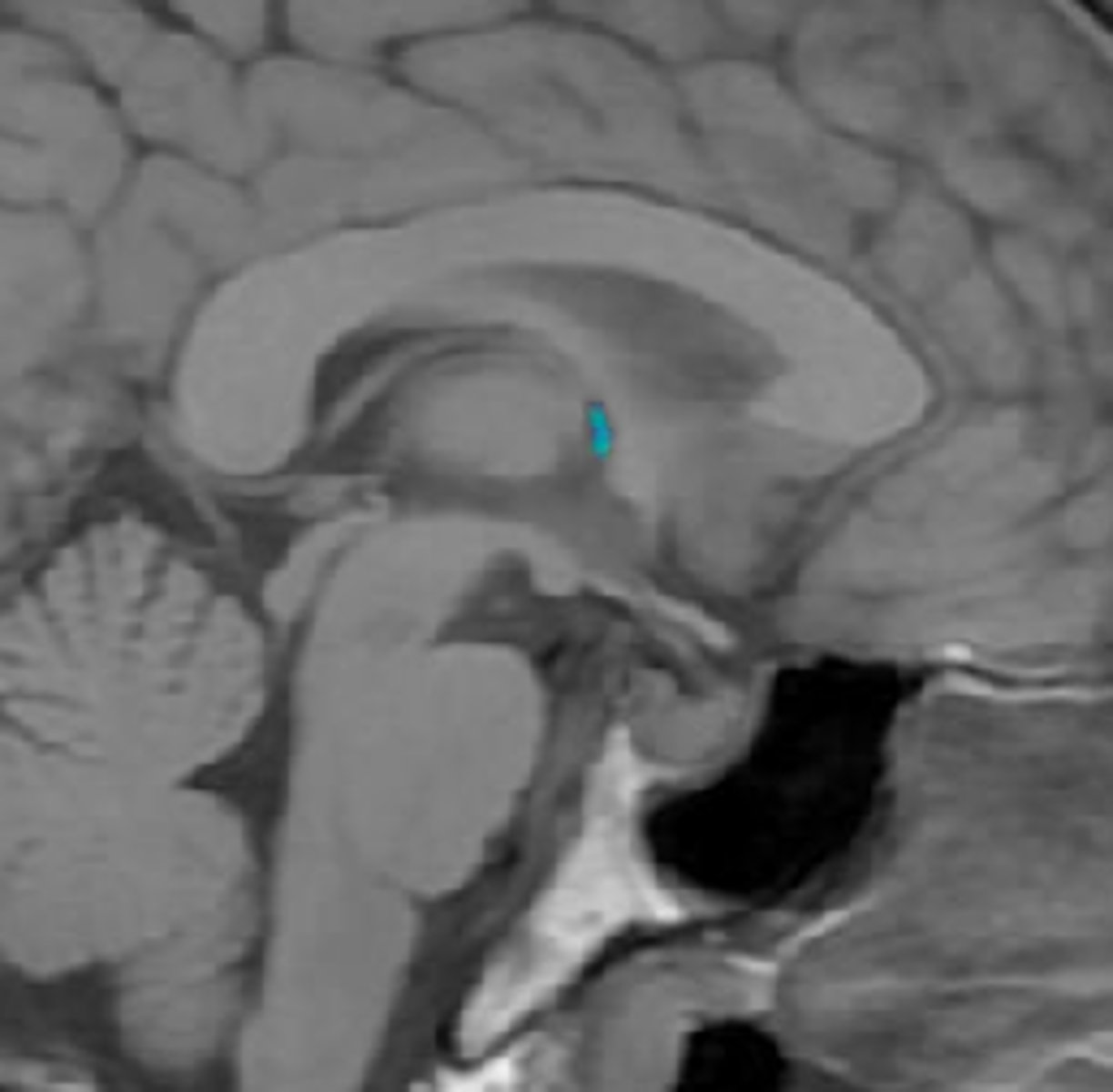 <p>connects lateral ventricles to 3rd ventricle</p>