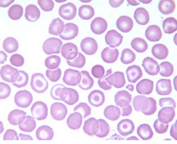 <p>A peripheral smear with red blood cells photographed in a typical field was submitted for review. All of the following conditions are most likely associated with the red blood cell population found here, EXCEPT:</p>