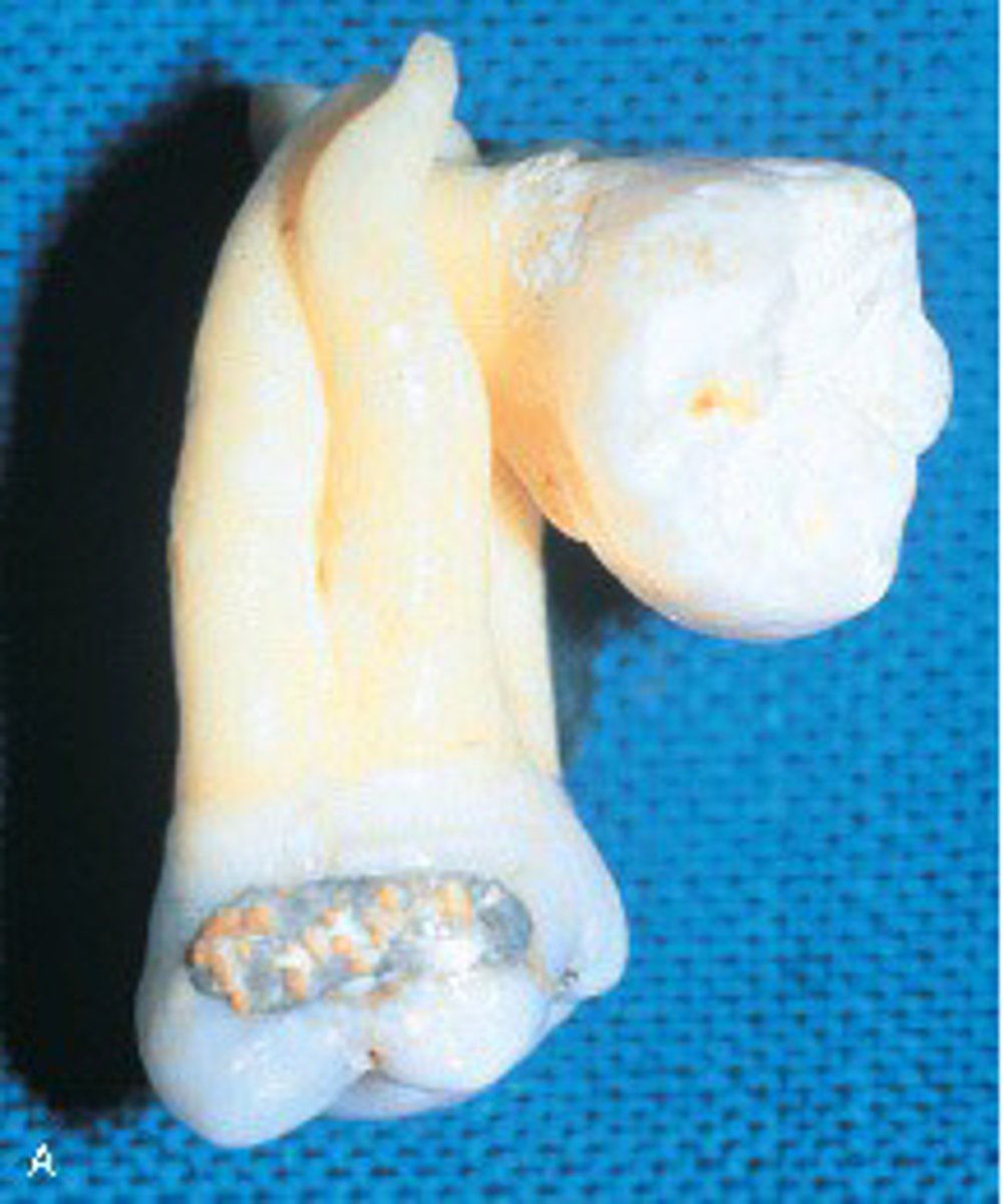 <p>concrescence.</p><p>Concrescence occurs when two adjacent teeth are united by cementum. Dilaceration refers to an abnormal curve or angle in the root. Enamel pearl is a small spherical enamel projection located on a root surface. Gemination occurs when a single enamel organ (tooth germ) divides partially.</p>