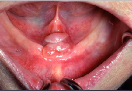 <p>what is the most likely cause of this lesion </p>