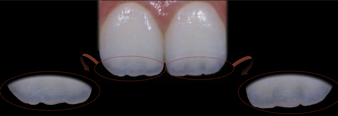 <p>At the incisal third, the incisal border is more opaque than the remainder of the incisal third.</p>