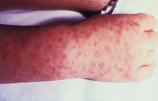 <p>caused by: Rickettsia rickettsia </p><p>Vector: ticks ( dog or wood)</p><ul><li><p>flu like </p></li><li><p>Rash is systemic ( clusters on the hands and feet </p></li><li><p>infects the endothelial cells </p><ul><li><p>multiples, exits, and explodes the cell </p></li><li><p>Takes a piece of the exploded cell and uses it to protect themselves from white blood cells </p></li></ul></li><li><p></p></li></ul><p></p>