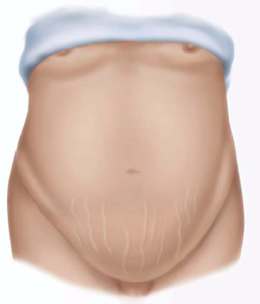 <p>a bulging abdomen, due to obesity; pendulous abdomen</p>