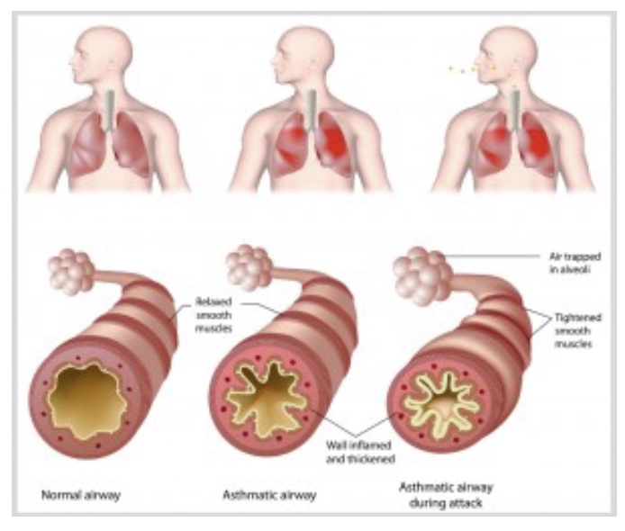 <p>-disrupts TV, so shut of breath and increase RR</p><p>-airway inflation → obstructive pattern in lungs</p><p>-Pulmonary function test=classic diagnostic tool</p><p>-reversible w/ meds, but not perfect (still some inflammation)</p><p>-asthma attack=narrow airways and mucus secretion</p>