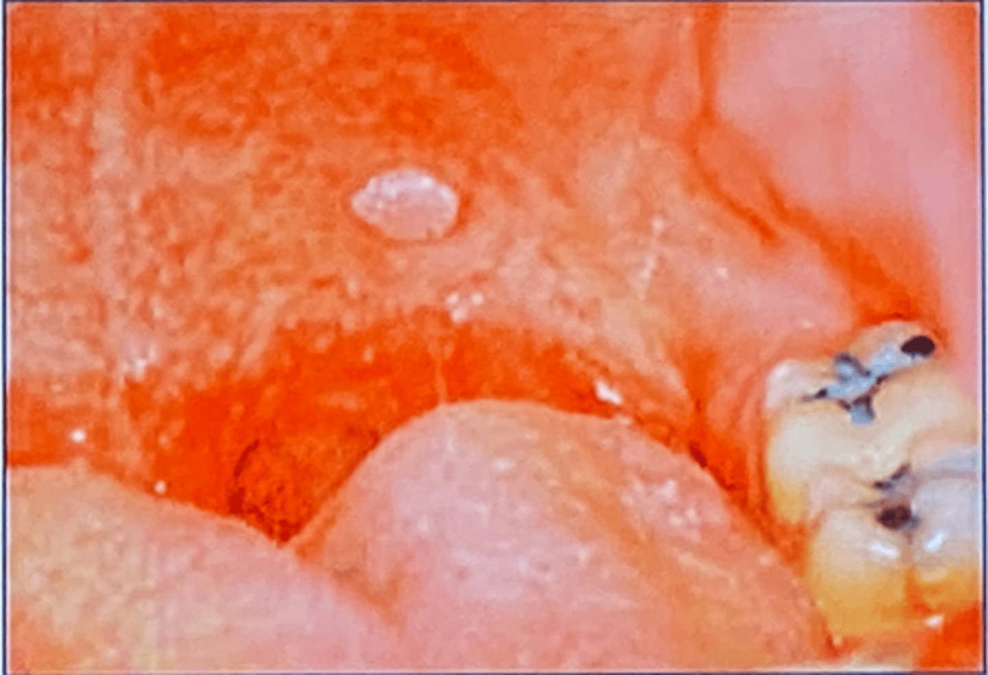 <p>What is you differential for the lesion pictured?</p>