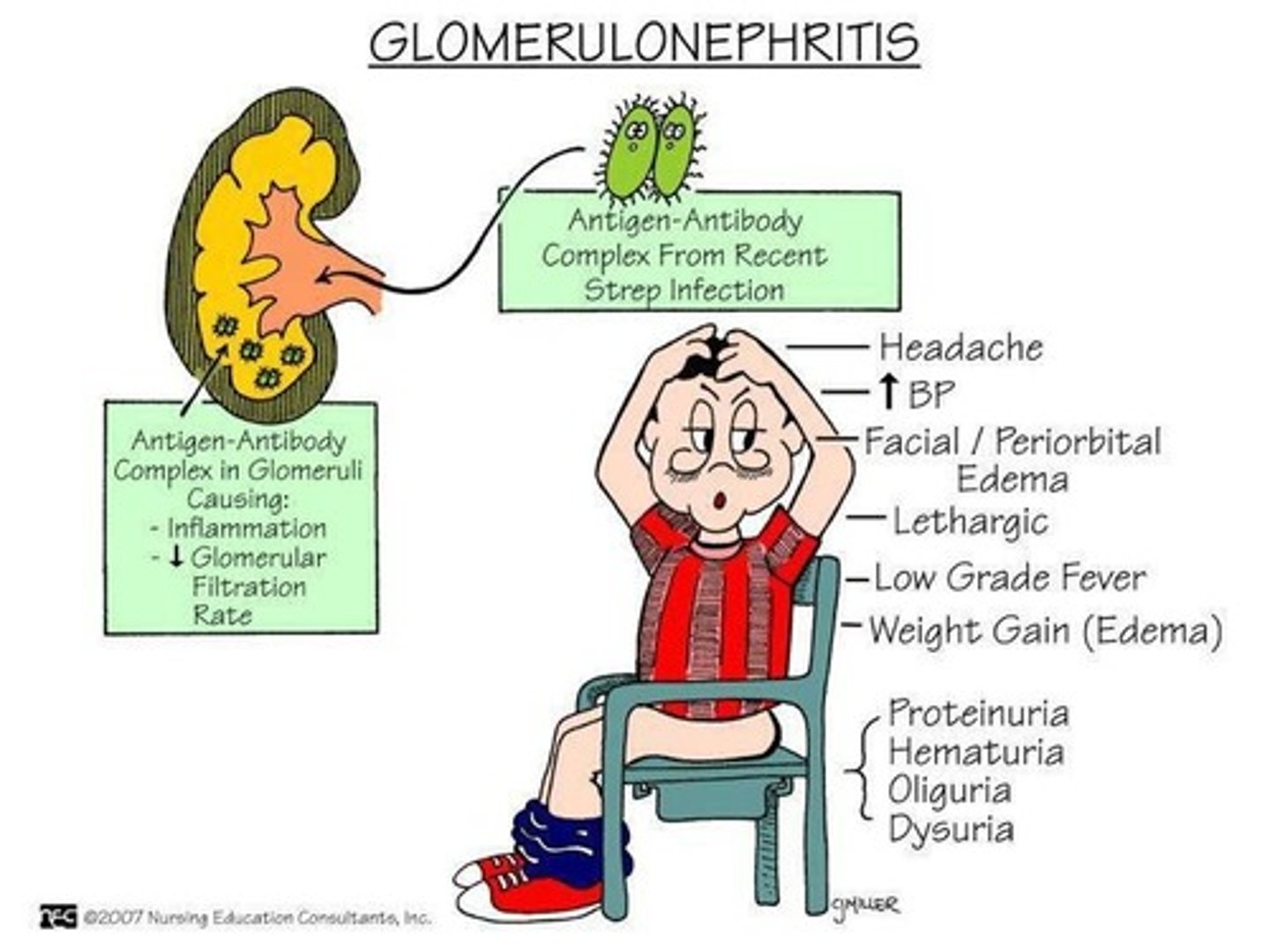 <p>1. inflammation of the tiny filters in the kidneys (glomeruli)</p><p>2.Toxins or medicines.</p><p>Viral infections, such as HIV, hepatitis B and C viruses.</p><p>Lupus-related kidney inflammation.</p>