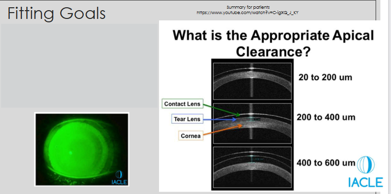 <ul><li><p>Clears (vaults) the central cornea</p></li><li><p>Increases limbal clearance</p><ul><li><p>Visible as a bright ring of fluorescein above the limbus</p></li></ul></li><li><p>Scleral alignment</p><ul><li><p>All pressure, weight, and bearing of the lens should be on the sclera</p></li></ul></li></ul><p></p>