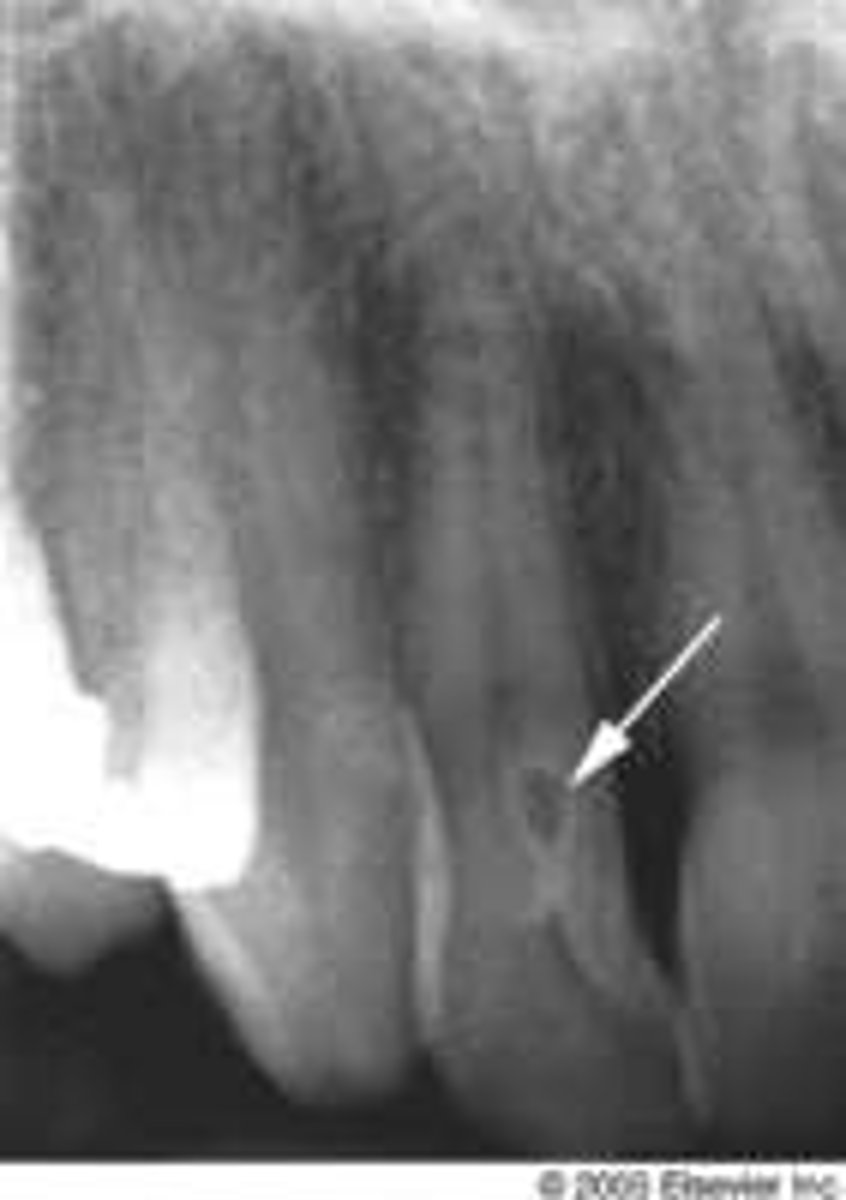 <p>Tooth within a tooth</p>