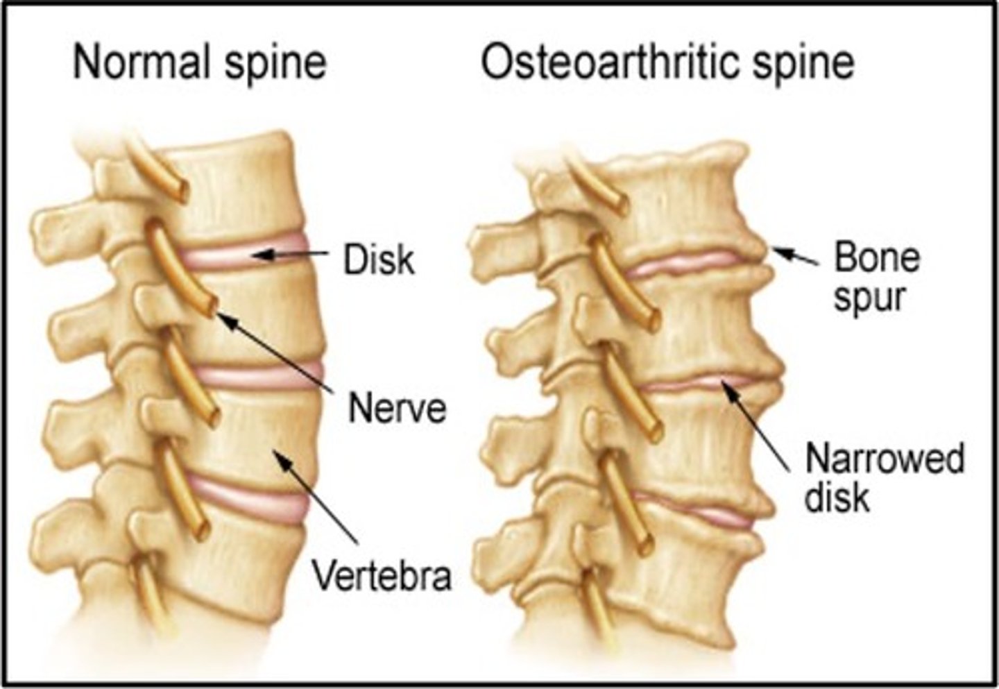 <p>- discs are compressed and distorted by UV osteophytes and disc protrusions</p><p>- with disc space narrowing, UV osteophytes can project into the IV foramina and into spinal canal and compress structures there (nerve roots, vertebral arteries, spinal cord)</p>