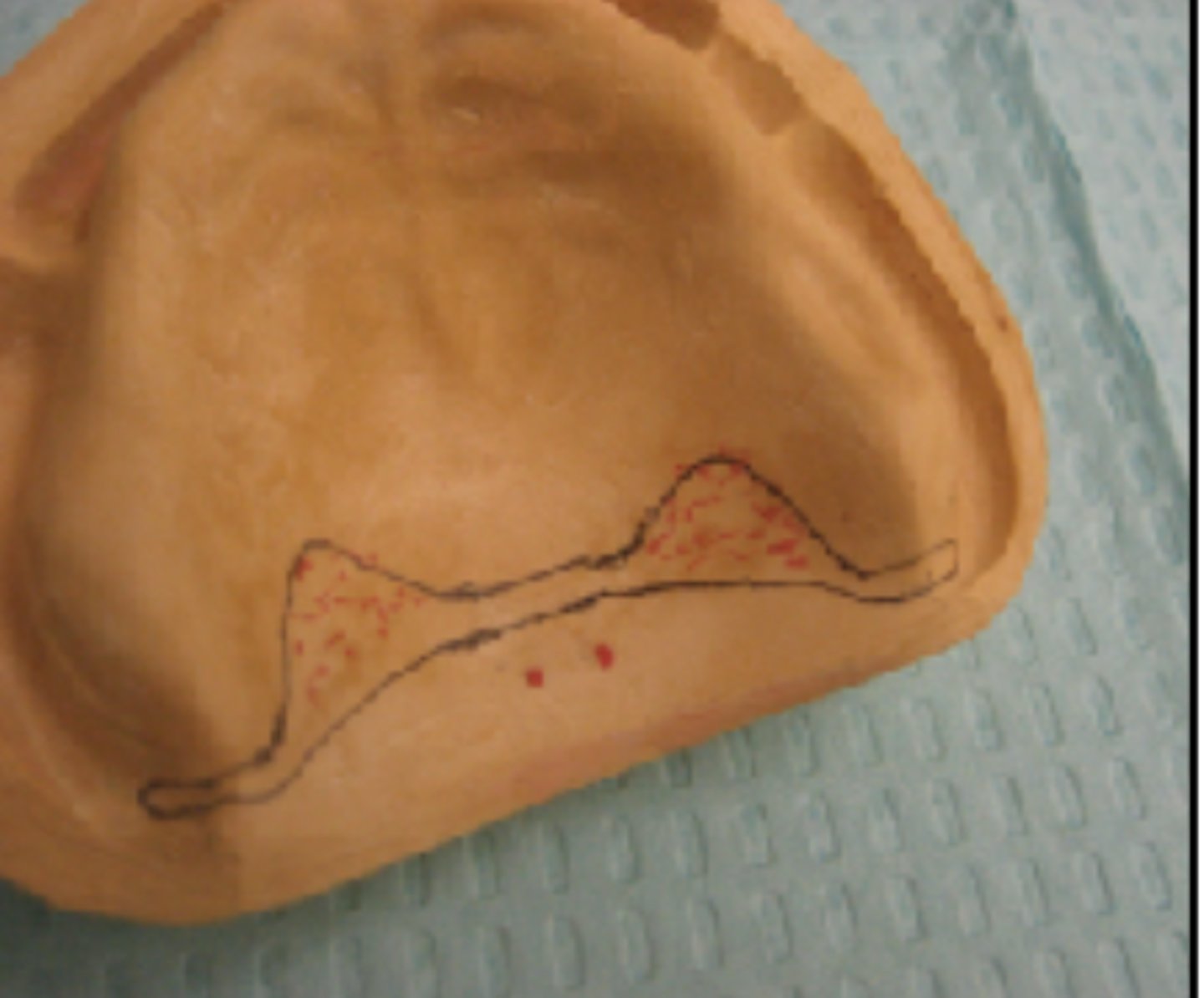 <p>What is the line called that is drawn 3mm anterior to the posterior line at the midline?</p>